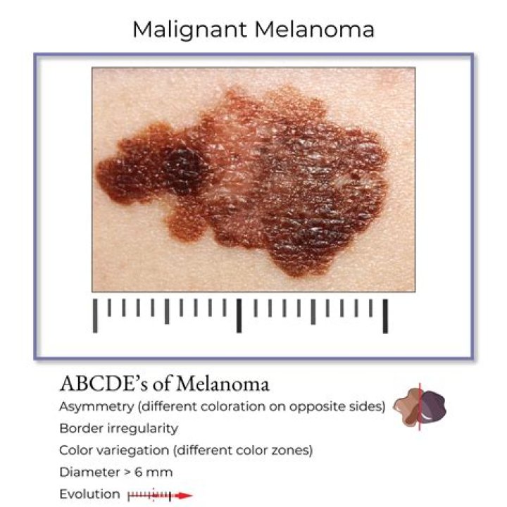 What type of melanoma is benign?