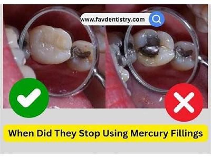 When did dentist stop using mercury fillings?