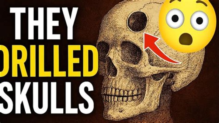 When did doctors drill holes in skulls?