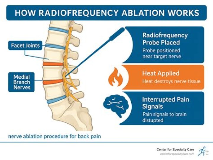 When is an ablation necessary?
