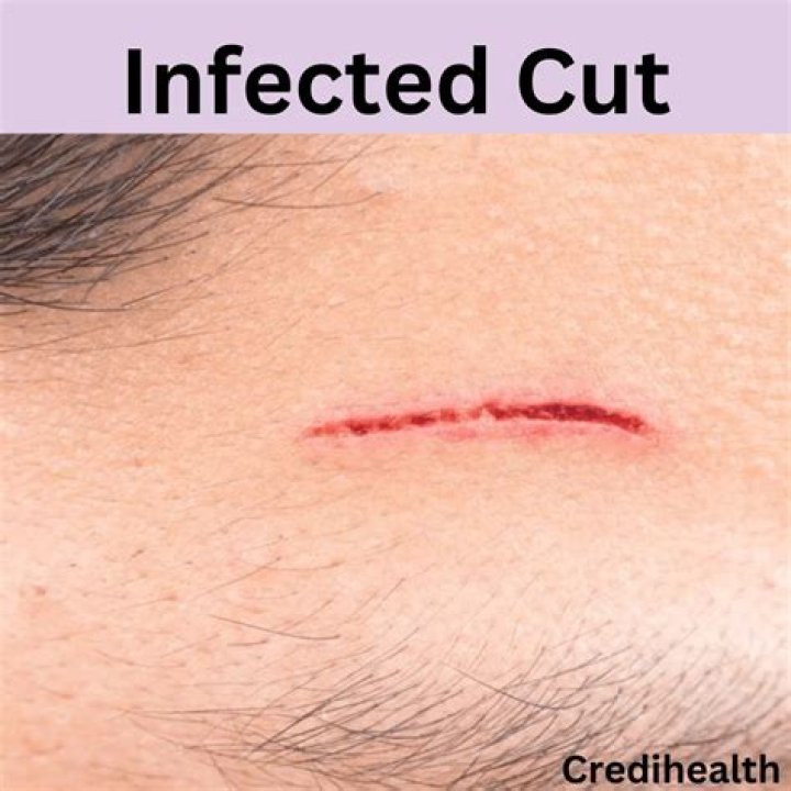 When should I go to the ER for an infected cut?