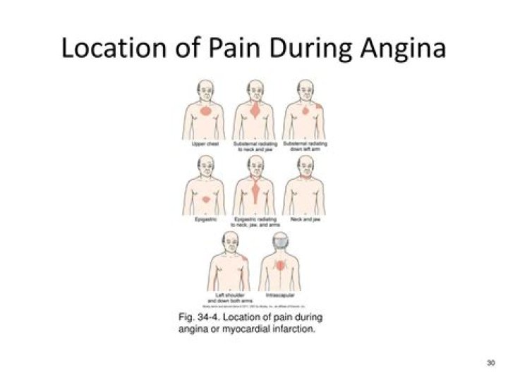 Where is angina pain located?