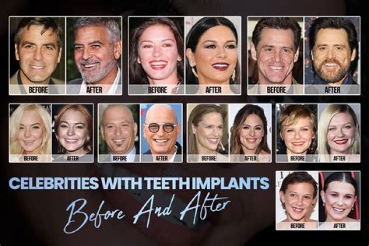 Which celebrities have had dental implants?