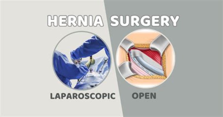Which is better hernia surgery open or laparoscopic surgery?