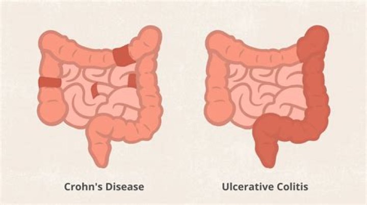 Which is worse Crohn's or colitis?