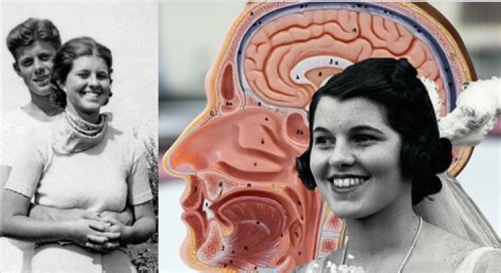 Which presidents daughter had a lobotomy?