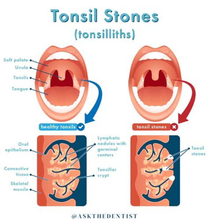 Why are my tonsil stones so big?