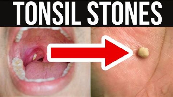 Why are some people's tonsils so big?