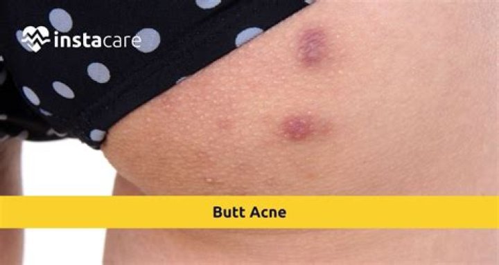 Why do I have a pimple on my butt?