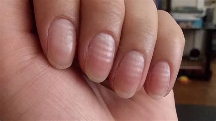 Why do I have big dents in my nails?
