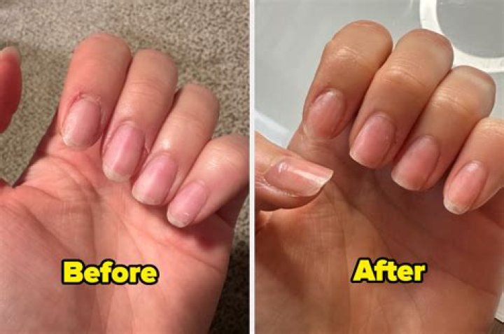Why do my nails hurt after removing shellac?