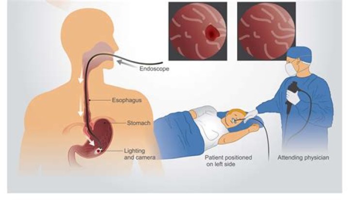 Why do you lay on your left side for an endoscopy?