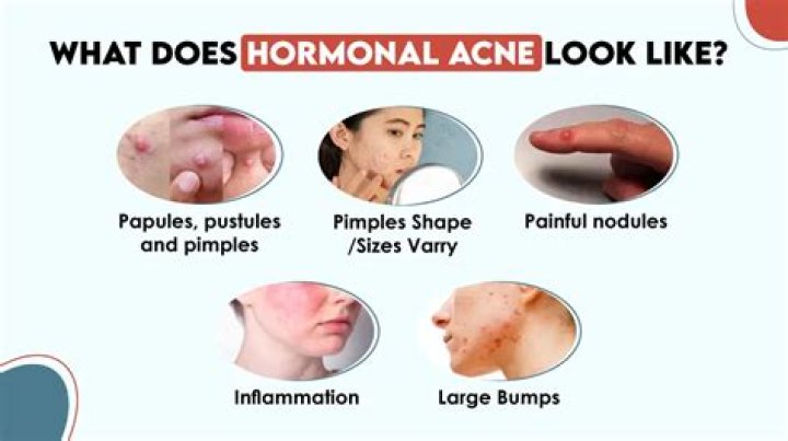 Why does acne look worse after shower?