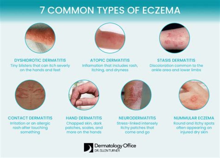 Why does eczema spread when you scratch it?