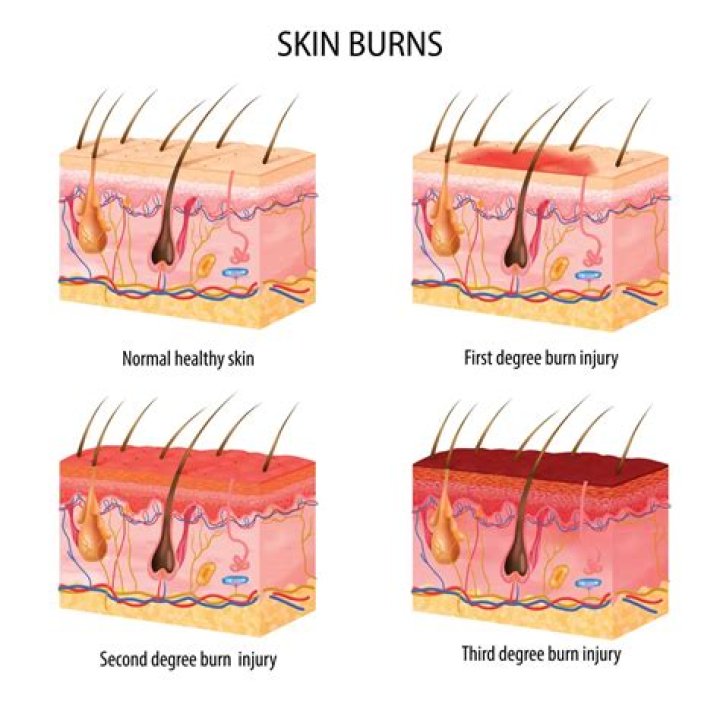 Why is my burn turning white?