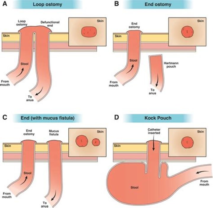 Why is my stoma output black?