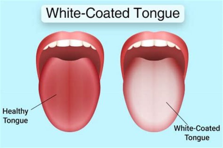 Why is my tongue always coated?