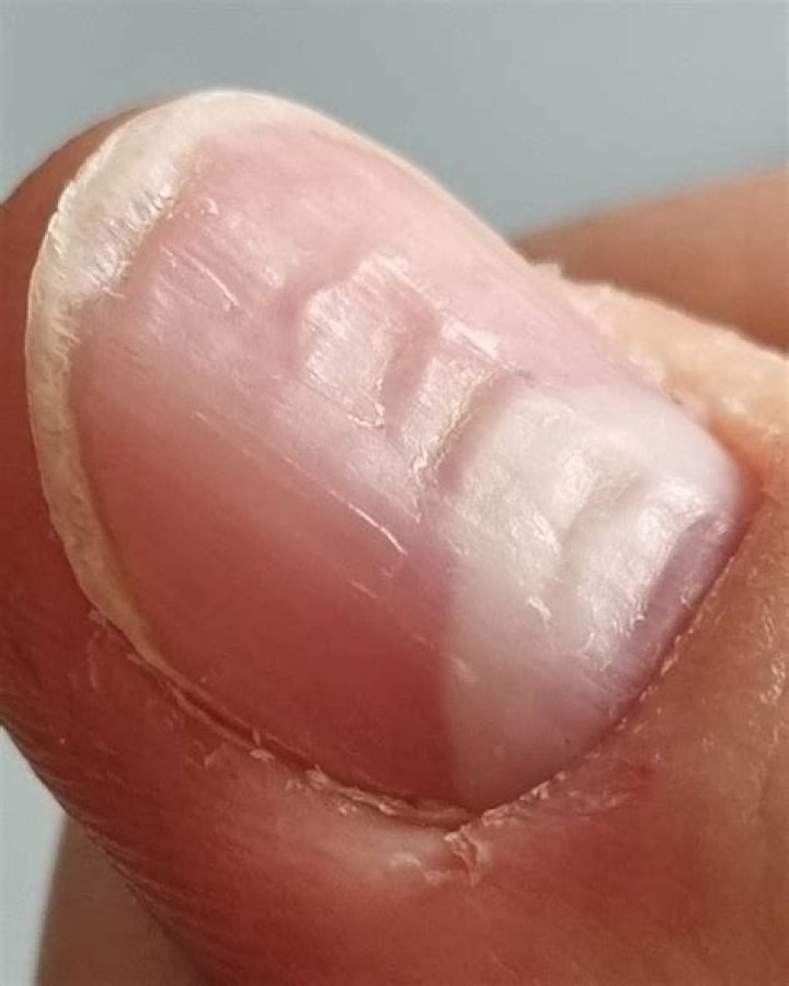 Why is there a bump under my nail?