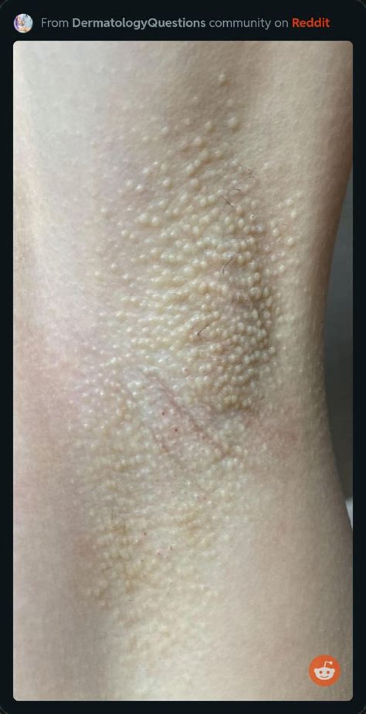 Why is there white stuff in my armpit?