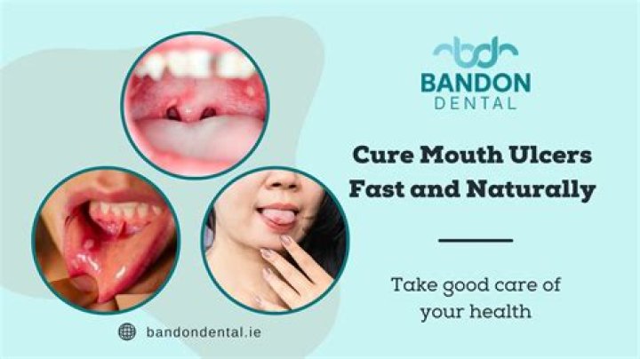 Why won't my mouth ulcers go away?