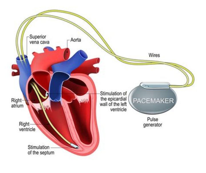 Will a pacemaker help AFib?