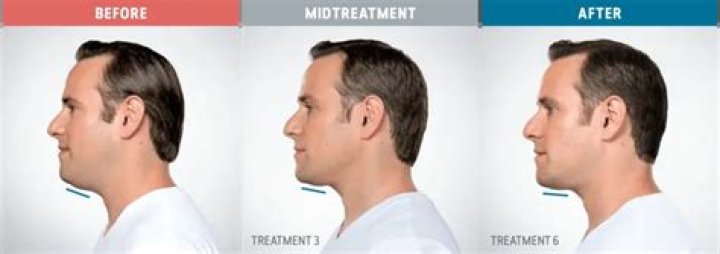 Will double chin go away with weight loss?