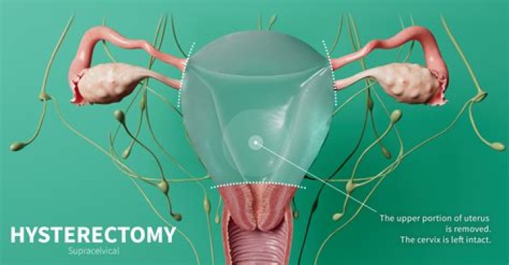 Will getting a hysterectomy get rid of HPV?