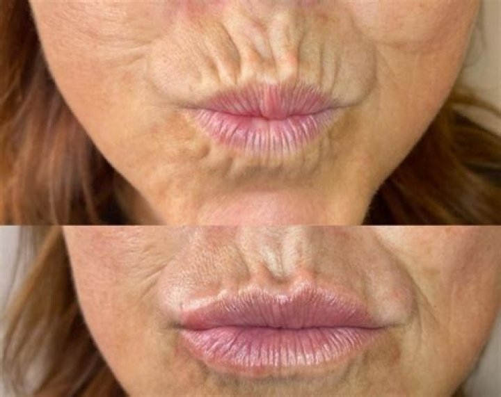 Will Retin-A help wrinkles around mouth?